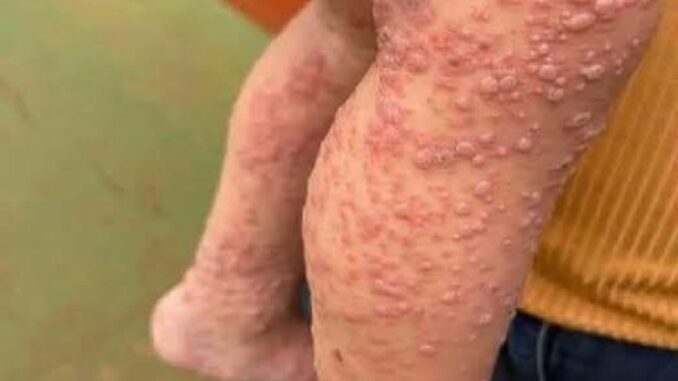 His whole body was itchy, he thought it was an allergy and was diagnosed…See more
