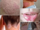 Signs of Human Papillomavirus (HPV) You Shouldn’t Ignore