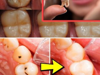 How to Naturally Repair a Cavity: Tips to Keep Your Teeth Strong & Avoid the Dentist