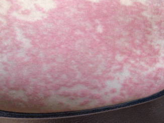 Her Whole Body Was Itchy: What She Thought Was a Common Allergy Was Hiding Something More Serious