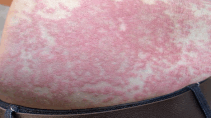 Her Whole Body Was Itchy: What She Thought Was a Common Allergy Was Hiding Something More Serious Her Whole Body Was Itchy: What She Thought Was a Common Allergy Was Hiding Something More Serious