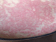 Her Whole Body Was Itchy: What She Thought Was a Common Allergy Was Hiding Something More Serious