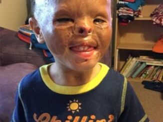 Foster baby is adopted 7 years after apartment fire left him with horrific burns