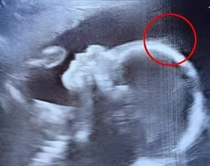 The doctors couldn’t believe what they saw during the ultrasound. But when the baby was born, her charm, strength, and story touched hearts around the world in the most unexpected ways. The doctors couldn’t believe what they saw during the ultrasound. But when the baby was born, her charm, strength, and story touched hearts around the world in the most unexpected ways.