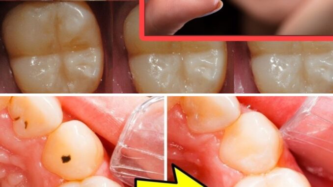 How to Naturally Repair a Cavity: Tips to Keep Your Teeth Strong & Avoid the Dentist