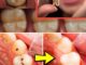 How to Naturally Repair a Cavity: Tips to Keep Your Teeth Strong & Avoid the Dentist