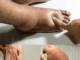 The Best Foods to Help Reduce Swollen Hands and Feet Naturally