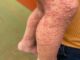 His whole body was itchy, he thought it was an allergy and was diagnosed…See more