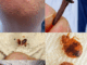 Natural Pest Control: Eliminate Bed Bugs and Household Pests with Diatomaceous Earth & Cloves